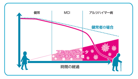 アルツハイマー病発症までの経緯